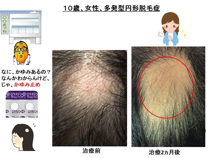 円形脱毛症　病院